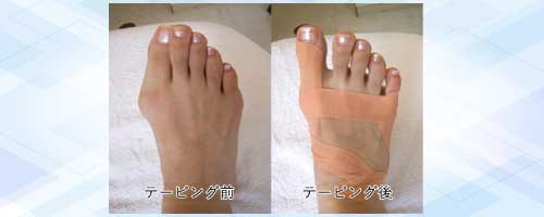笠原式治療は、理想の足の状態にして、テーピング固定します。