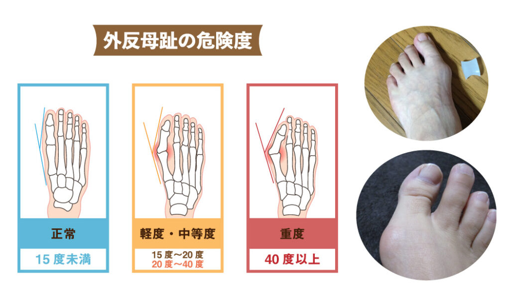 外反母趾の危険度