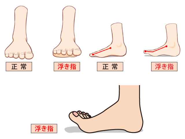 浮き指(ゆきゆび)足の指が地面に接していない状態
