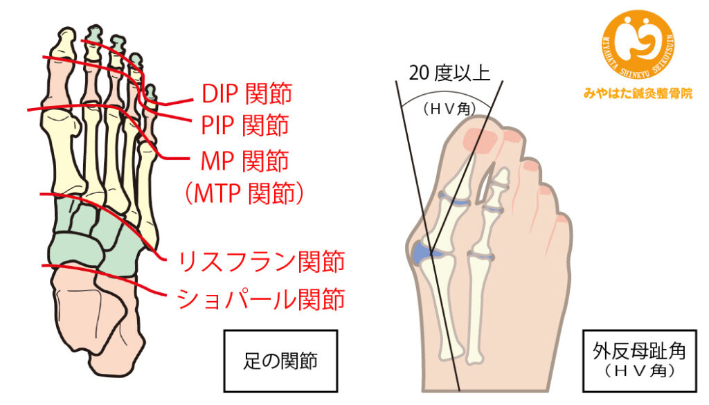 外反母趾の定義