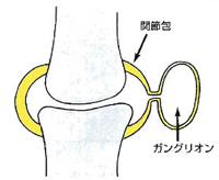 ガングリオン