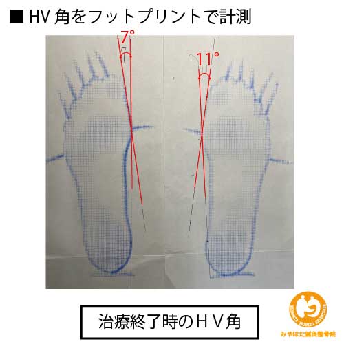 （治療終了時）外反母趾（症例１）４１歳女性