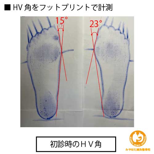 （初診時のフットプリント）外反母趾（症例２）４０歳女性