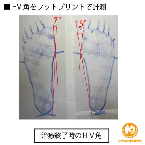 （治療終了時のフットプリント）外反母趾（症例２）４０歳女性