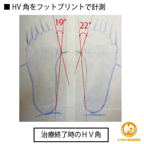 （治療終了時のフットプリント）外反母趾（症例３）５５歳女性