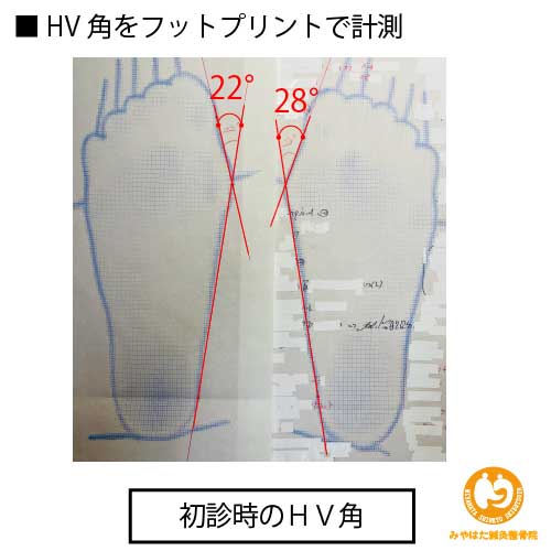 （初診時のフットプリント）外反母趾（症例４）４１歳女性