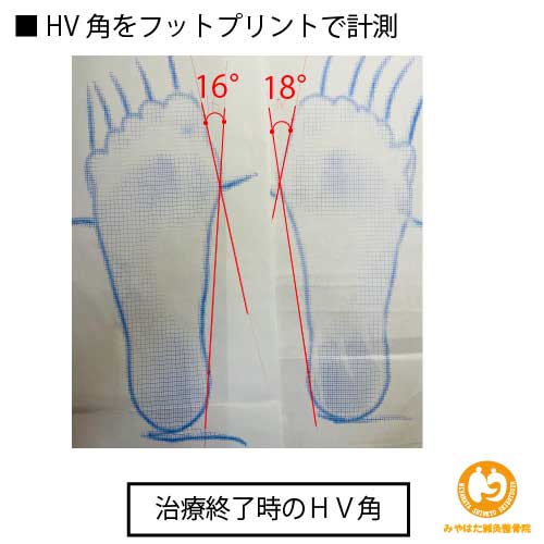 （治療終了時）フットプリント外反母趾（症例４）４１歳女性