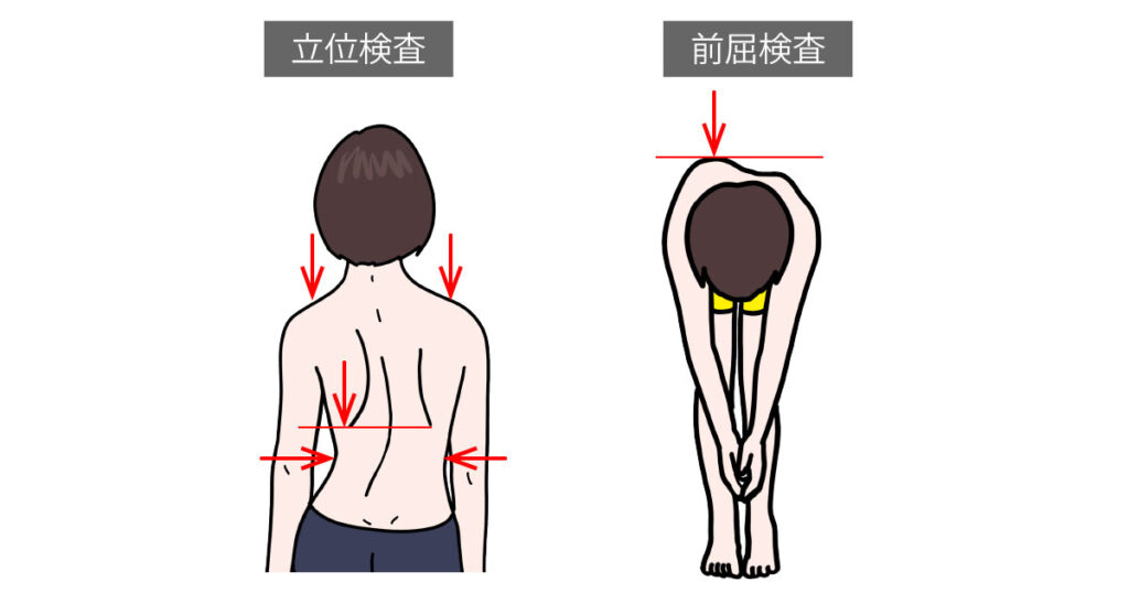 側弯症の定義