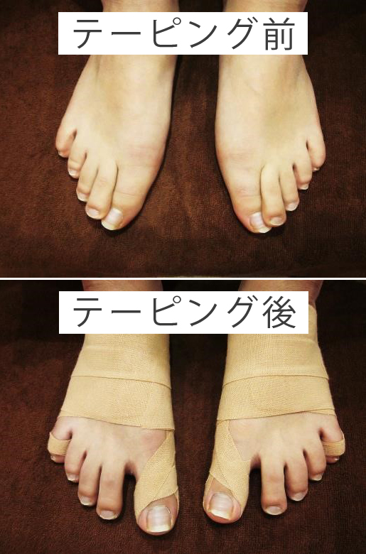 テーピング